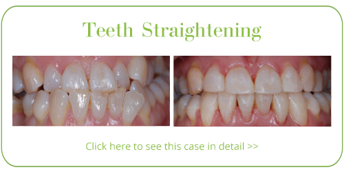 Teeth Straightening Skegness